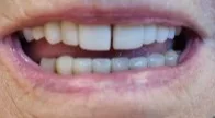 Restoring Confidence with a Combination Treatment for Missing Teeth after image