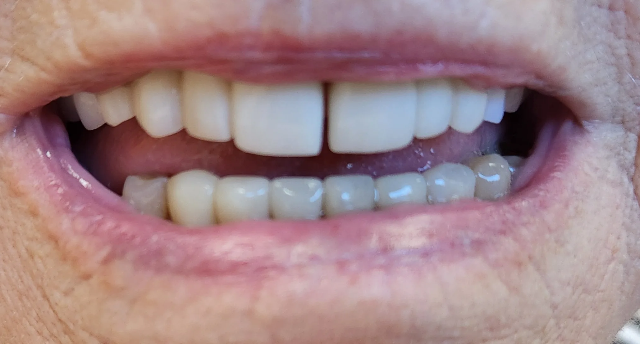 Restoring Confidence with a Combination Treatment for Missing Teeth after image